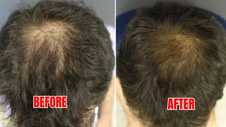 Regrow Hair in 30 Days Naturally